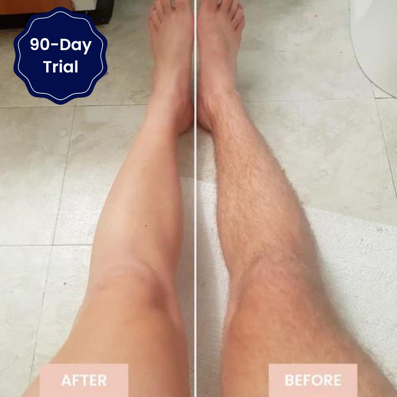 Smooth Skin No Bumps, Burns, Or Irritation - SmoothBeam